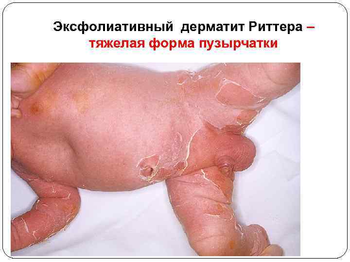Эксфолиативный дерматит Риттера – тяжелая форма пузырчатки 