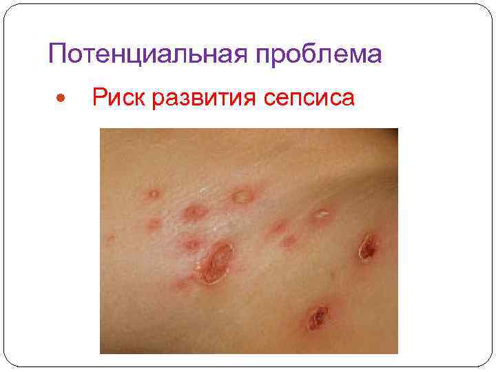 Потенциальная проблема Риск развития сепсиса 