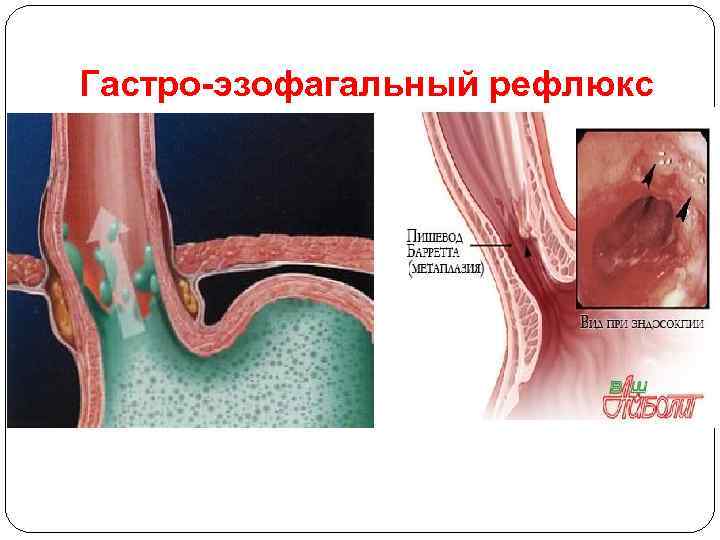 Гастро-эзофагальный рефлюкс 