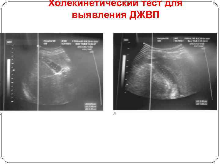 Холекинетический тест для выявления ДЖВП 