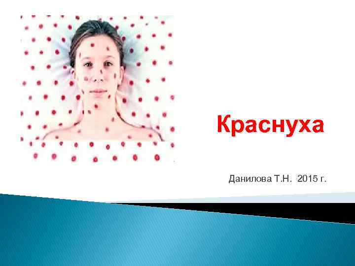 Краснуха Данилова Т. Н. 2015 г. 