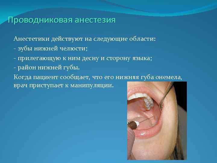 Проводниковая анестезия Анестетики действуют на следующие области: - зубы нижней челюсти; - прилегающую к