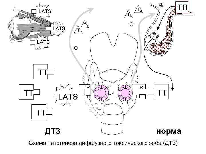 Патогенез дтз схема