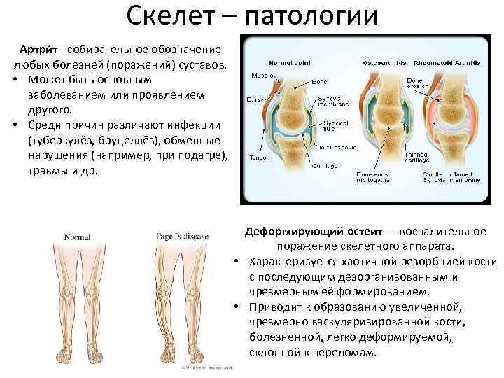 Скелет – патологии Артри т - собирательное обозначение любых болезней (поражений) суставов. • Может