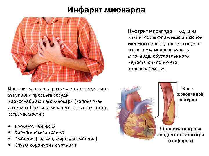 Инфаркт миокарда — одна из клинических форм ишемической болезни сердца, протекающая с развитием некроза