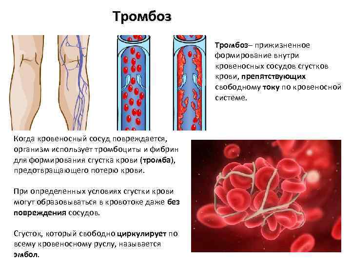 Тромбофлебит артерий