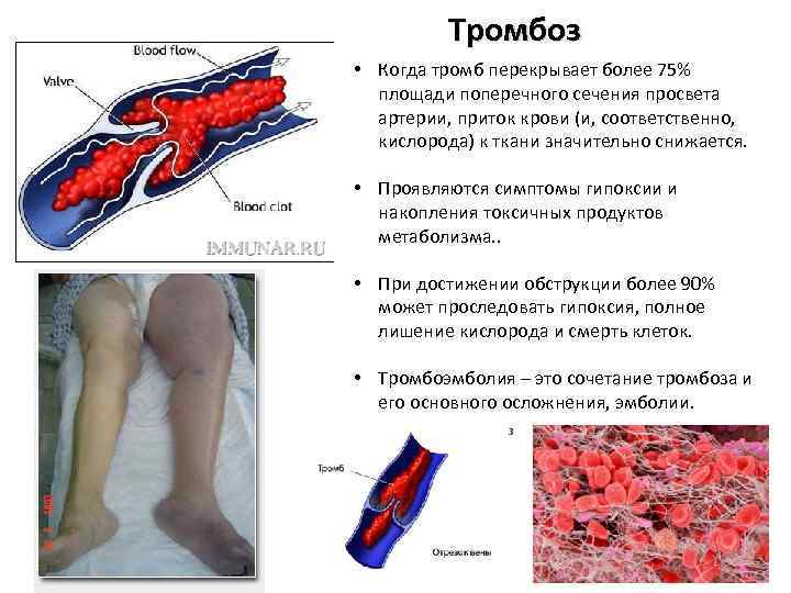 Тромбоз • Когда тромб перекрывает более 75% площади поперечного сечения просвета артерии, приток крови