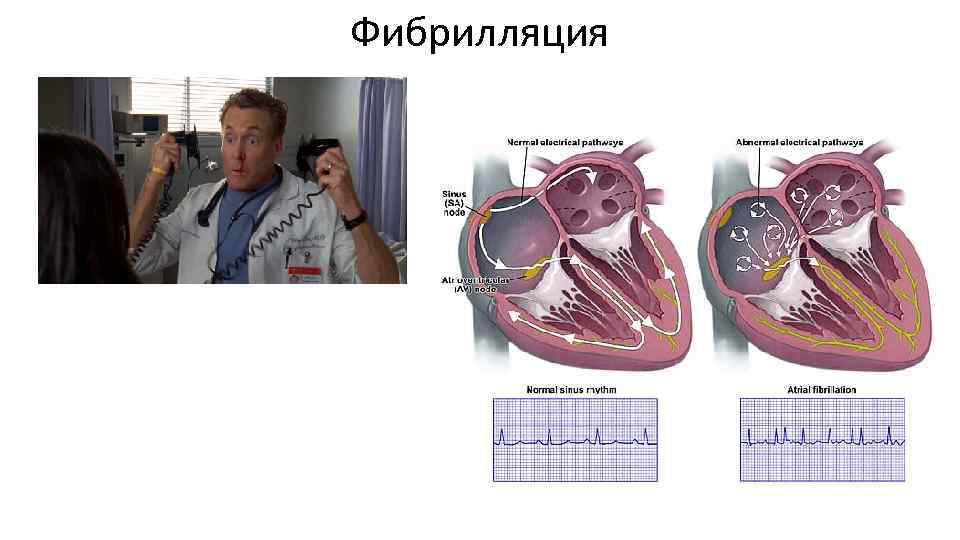 Фибрилляция 