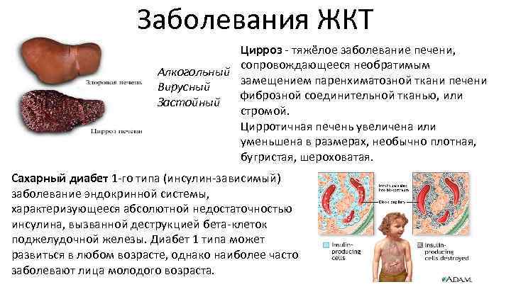 Заболевания ЖКТ Цирроз - тяжёлое заболевание печени, сопровождающееся необратимым Алкогольный замещением паренхиматозной ткани печени