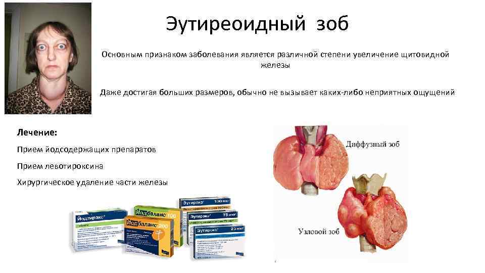 Эутиреоидный зоб Основным признаком заболевания является различной степени увеличение щитовидной железы Даже достигая больших