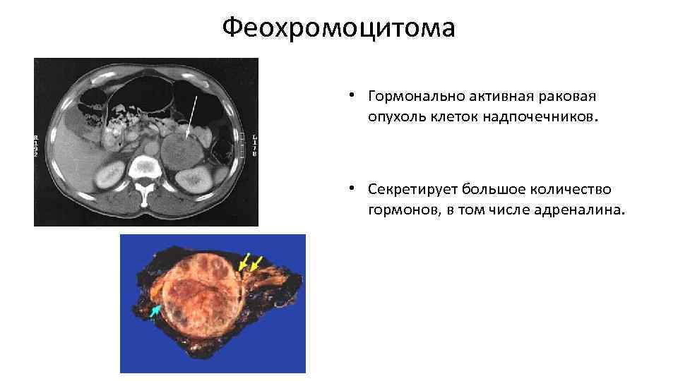 Феохромоцитома • Гормонально активная раковая опухоль клеток надпочечников. • Секретирует большое количество гормонов, в