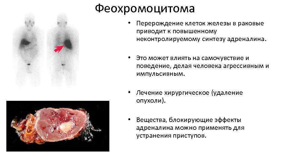 Феохромоцитома • Перерождение клеток железы в раковые приводит к повышенному неконтролируемому синтезу адреналина. •