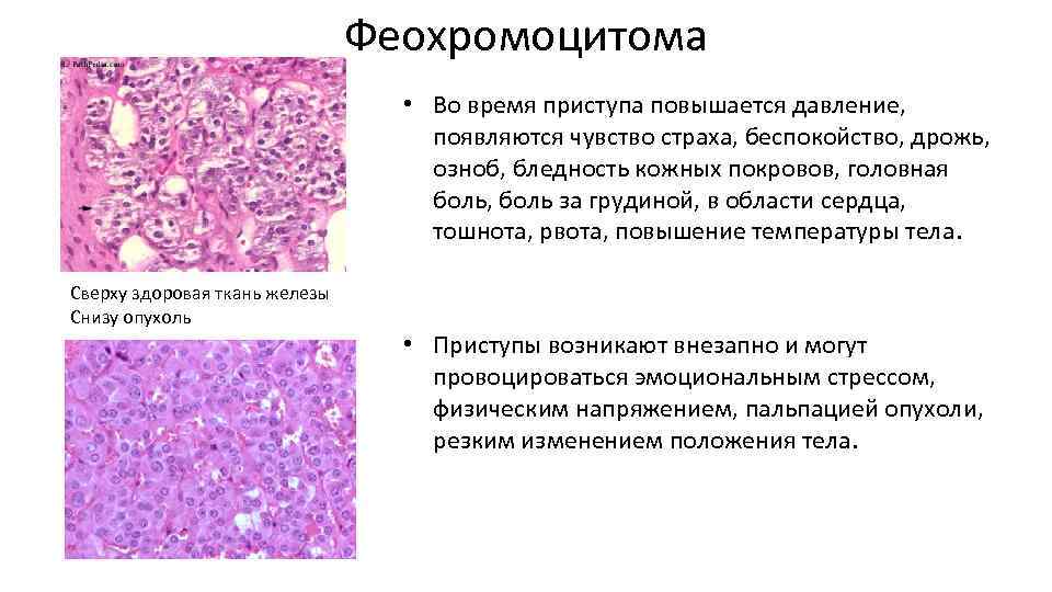 Патогенез феохромоцитомы схема