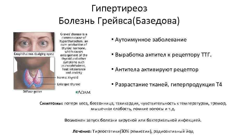 Гипертиреоз Болезнь Грейвса(Базедова) • Аутоимунное заболевание • Выработка антител к рецептору ТТГ. • Антитела
