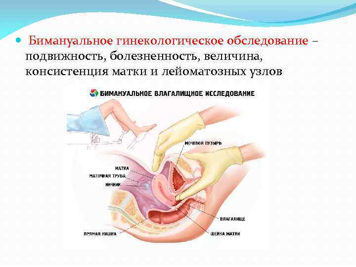  Бимануальное гинекологическое обследование – подвижность, болезненность, величина, консистенция матки и лейоматозных узлов 