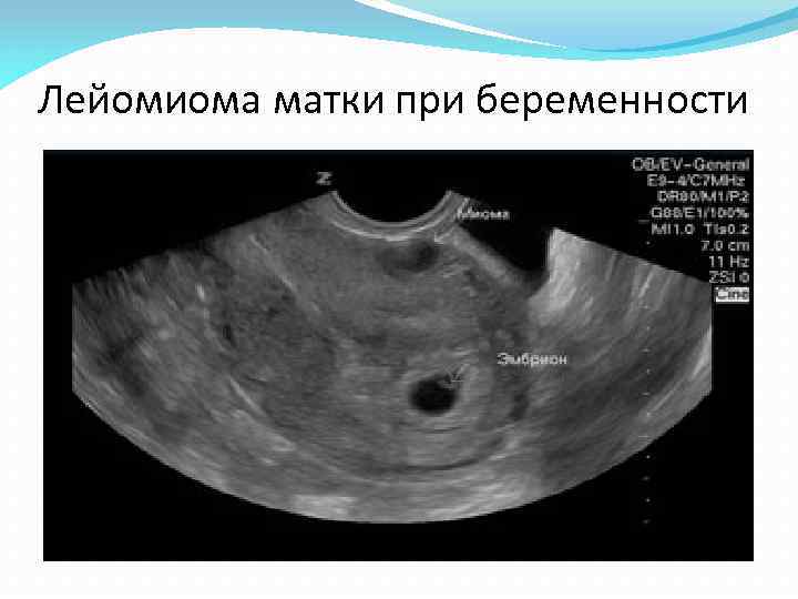 Лейомиома матки при беременности 