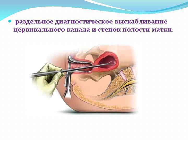  раздельное диагностическое выскабливание цервикального канала и стенок полости матки. 