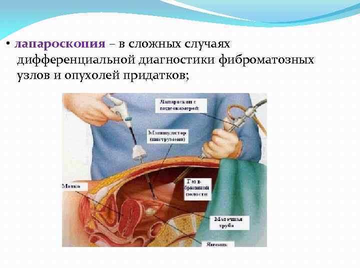  • лапароскопия – в сложных случаях дифференциальной диагностики фиброматозных узлов и опухолей придатков;