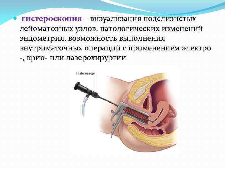  гистероскопия – визуализация подслизистых лейоматозных узлов, патологических изменений эндометрия, возможность выполнения внутриматочных операций