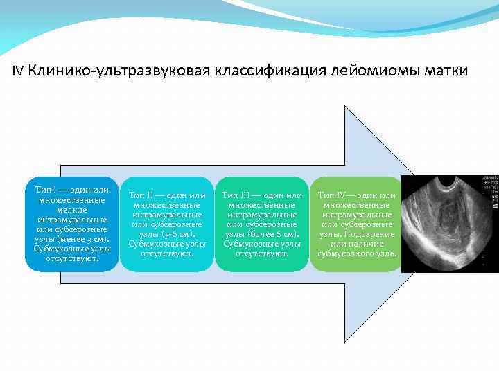 IV Клинико-ультразвуковая классификация лейомиомы матки Тип I — один или множественные мелкие интрамуральные или