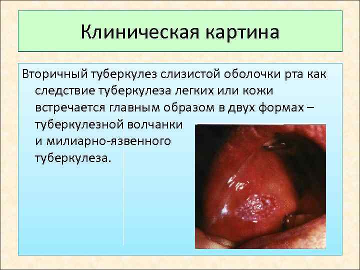 Клиническая картина Вторичный туберкулез слизистой оболочки рта как следствие туберкулеза легких или кожи встречается