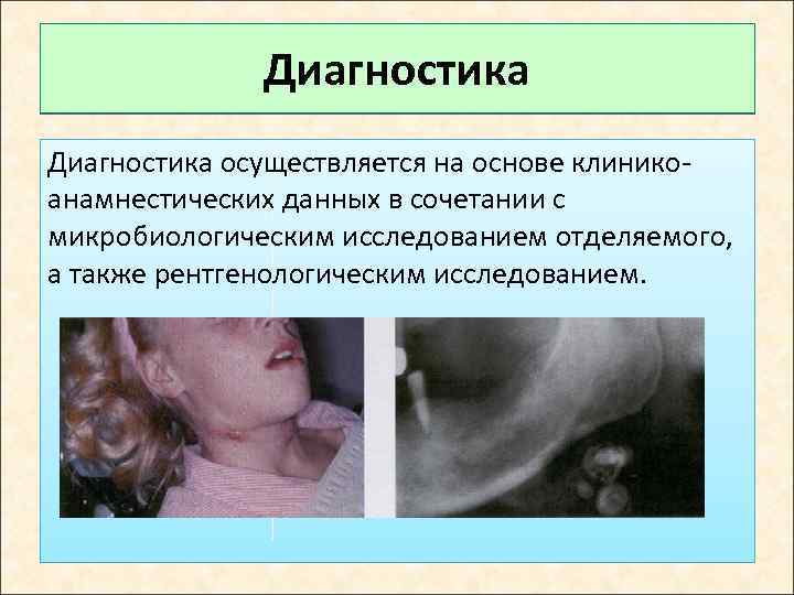 Диагностика осуществляется на основе клиникоанамнестических данных в сочетании с микробиологическим исследованием отделяемого, а также