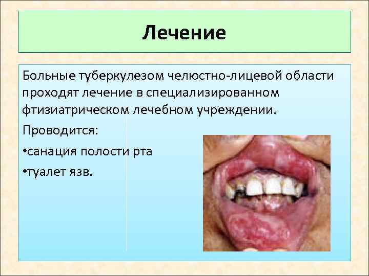Лечение Больные туберкулезом челюстно-лицевой области проходят лечение в специализированном фтизиатрическом лечебном учреждении. Проводится: •