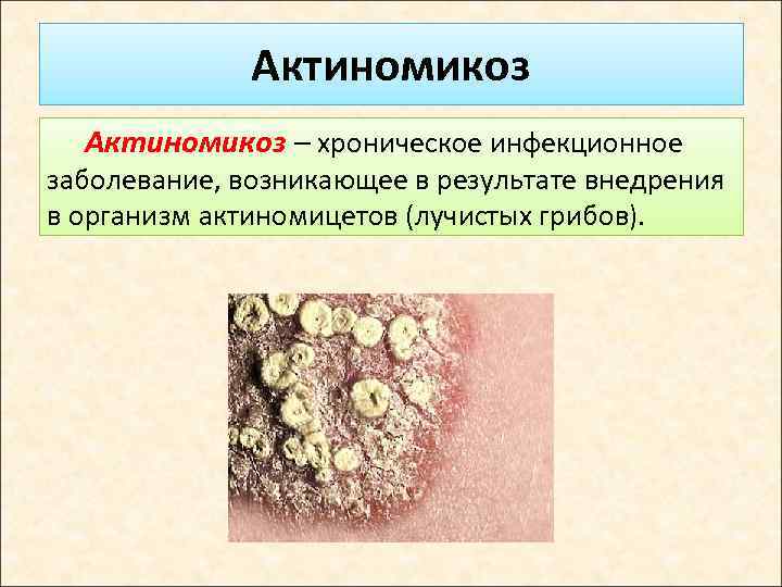 Актиномикоз – хроническое инфекционное заболевание, возникающее в результате внедрения в организм актиномицетов (лучистых грибов).