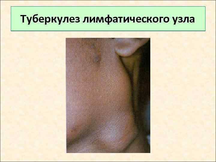 Туберкулез лимфатического узла 