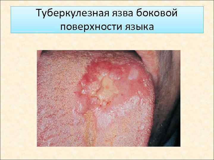 Туберкулезная язва боковой поверхности языка 