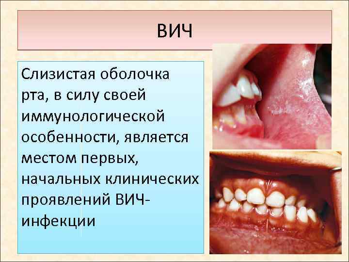 ВИЧ Слизистая оболочка рта, в силу своей иммунологической особенности, является местом первых, начальных клинических