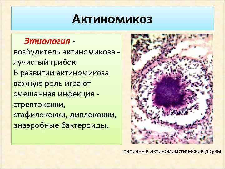 Актиномикоз Этиология - возбудитель актиномикоза - лучистый грибок. В развитии актиномикоза важную роль играют