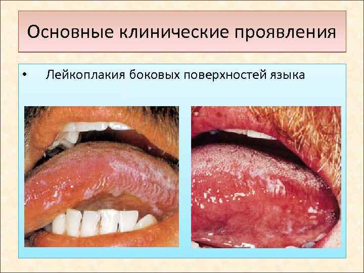 Основные клинические проявления • Лейкоплакия боковых поверхностей языка 