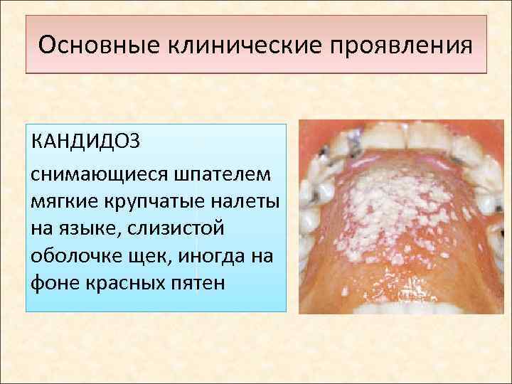 Основные клинические проявления КАНДИДОЗ снимающиеся шпателем мягкие крупчатые налеты на языке, слизистой оболочке щек,