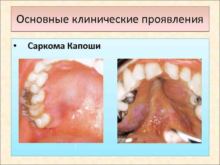 Основные клинические проявления • Саркома Капоши 