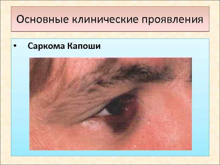 Основные клинические проявления • Саркома Капоши 