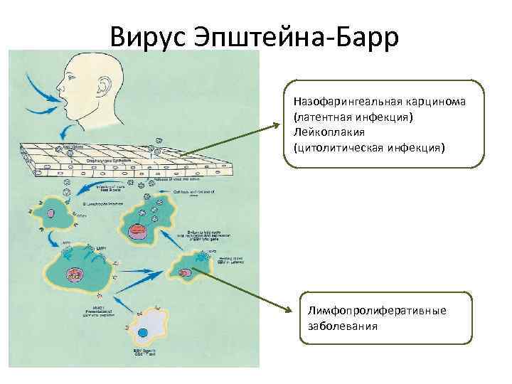 Вирус Эпштейна-Барр Назофарингеальная карцинома (латентная инфекция) Лейкоплакия (цитолитическая инфекция) Лимфопролиферативные заболевания 