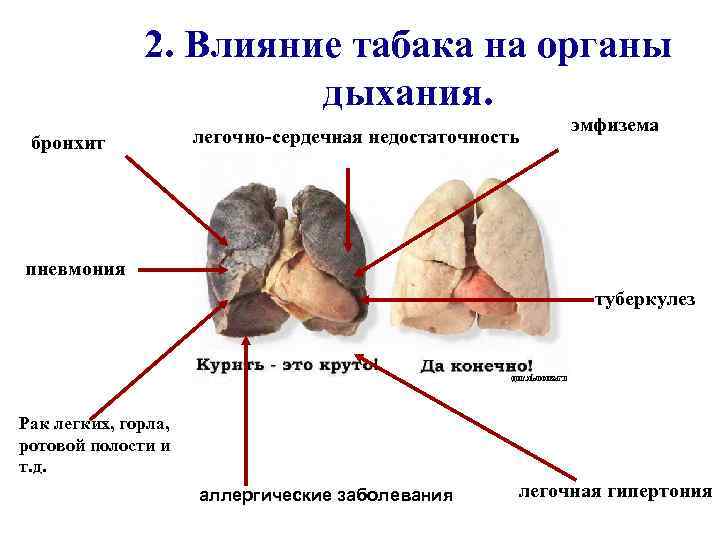 2. Влияние табака на органы дыхания. бронхит легочно-сердечная недостаточность эмфизема пневмония туберкулез Рак легких,