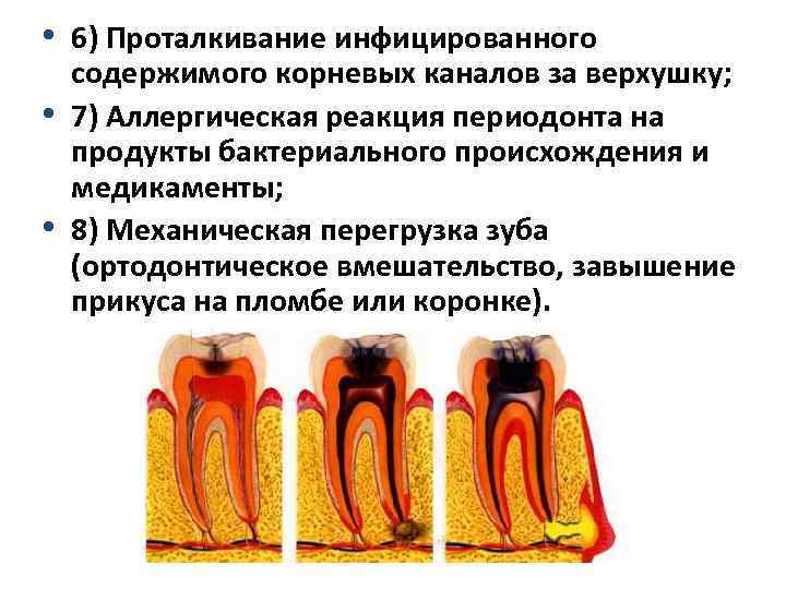  • 6) Проталкивание инфицированного содержимого корневых каналов за верхушку; • 7) Аллергическая реакция