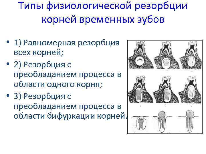 Физиологический вид. Стадии резорбции корней молочных зубов. Типы резорбции корней временных зубов. Физиологическая резорбция корней временных зубов. Физиологическая резорбция корней молочных зубов.