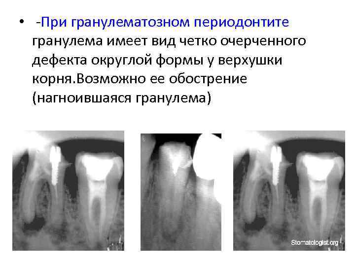 Лечение воспаления периодонтита. Гранулематозный периодонтит рентген.