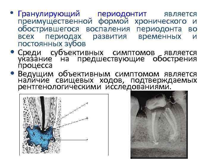 Рентгенологические признаки периодонтита