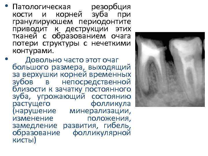 Гранулирующий периодонтит мкб