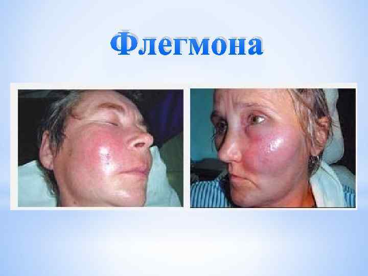 Флегмона 