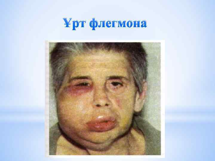 Ұрт флегмона 