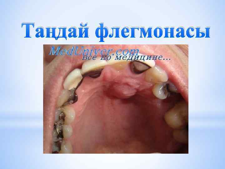 Таңдай флегмонасы 