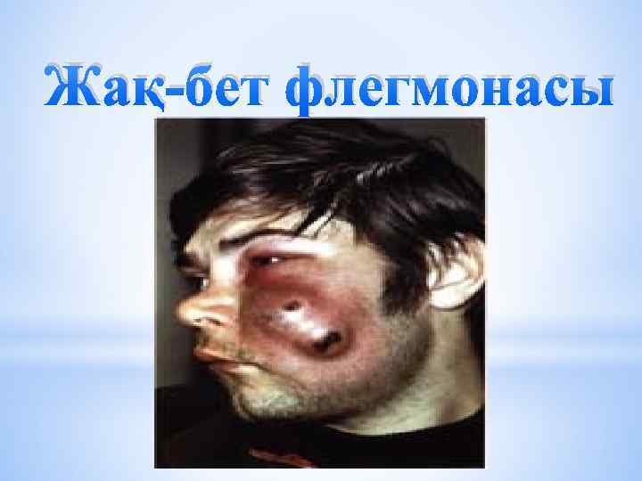 Жақ-бет флегмонасы 