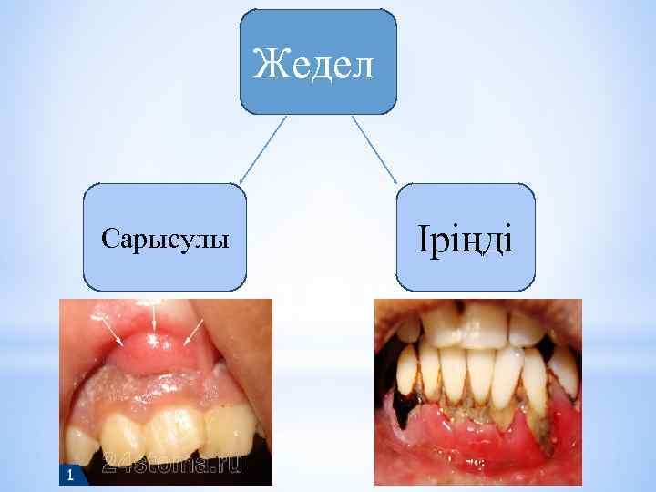 Жедел Сарысулы Іріңді 