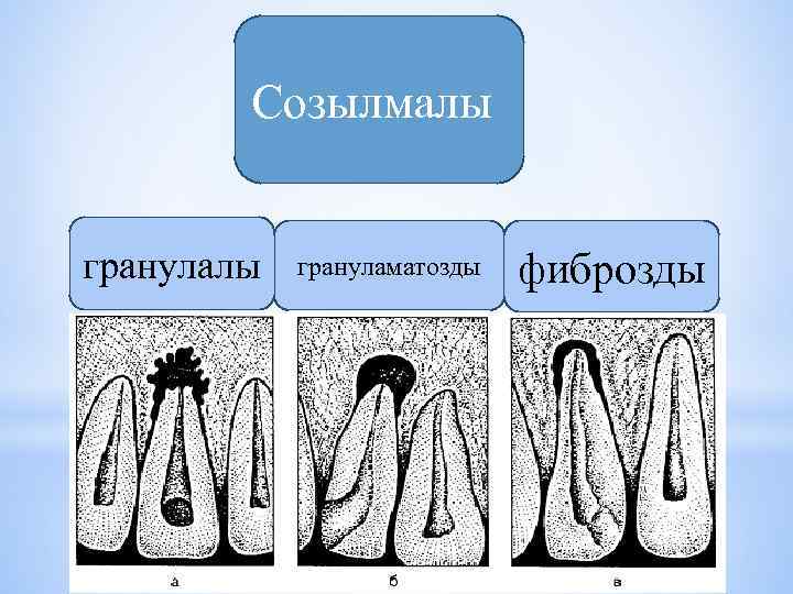 Созылмалы грануламатозды фиброзды 