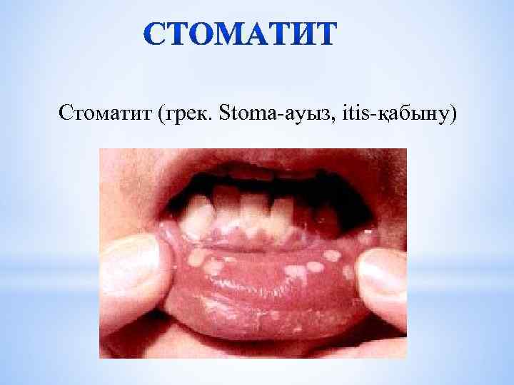 Стоматит (грек. Stoma-ауыз, itis-қабыну) 